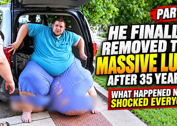 PART 2: He finally removed the massive lump after 35 years… but what happened next shocked everyone.