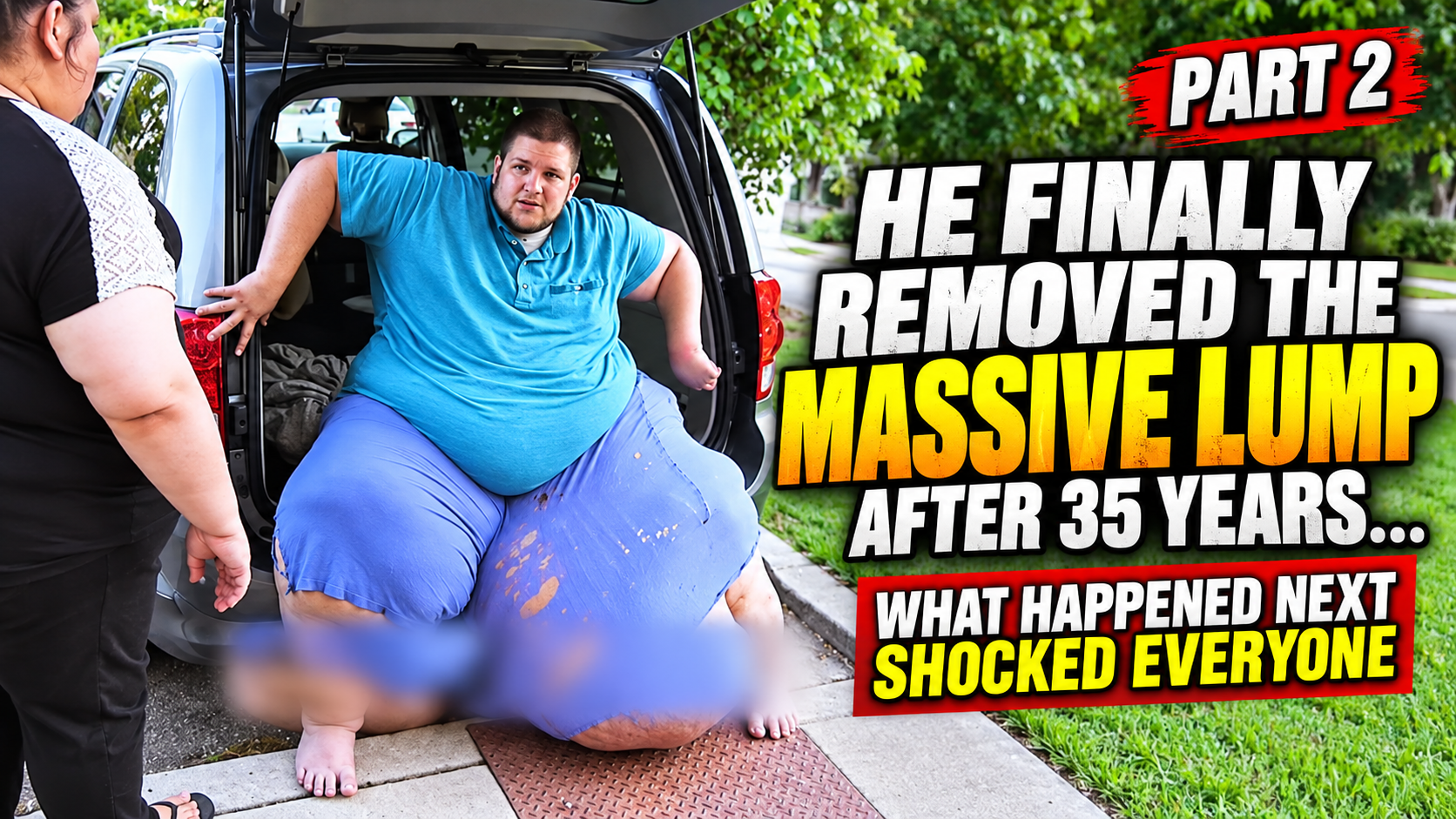 PART 2: He finally removed the massive lump after 35 years… but what happened next shocked everyone.